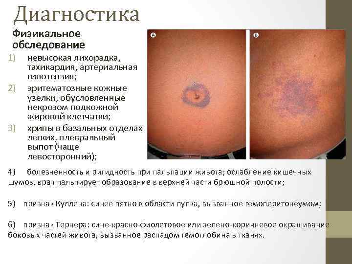 Диагностика Физикальное обследование 1) 2) 3) невысокая лихорадка, тахикардия, артериальная гипотензия; эритематозные кожные узелки,