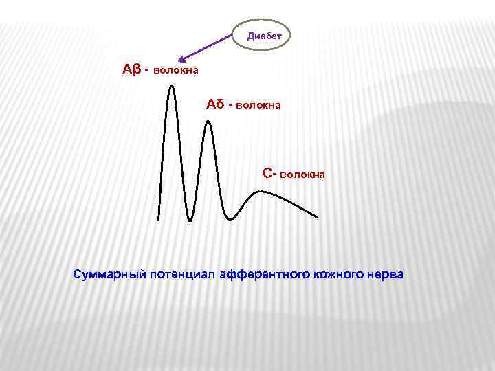 Диабет Аβ - волокна Аδ - волокна Суммарный потенциал афферентного кожного нерва 