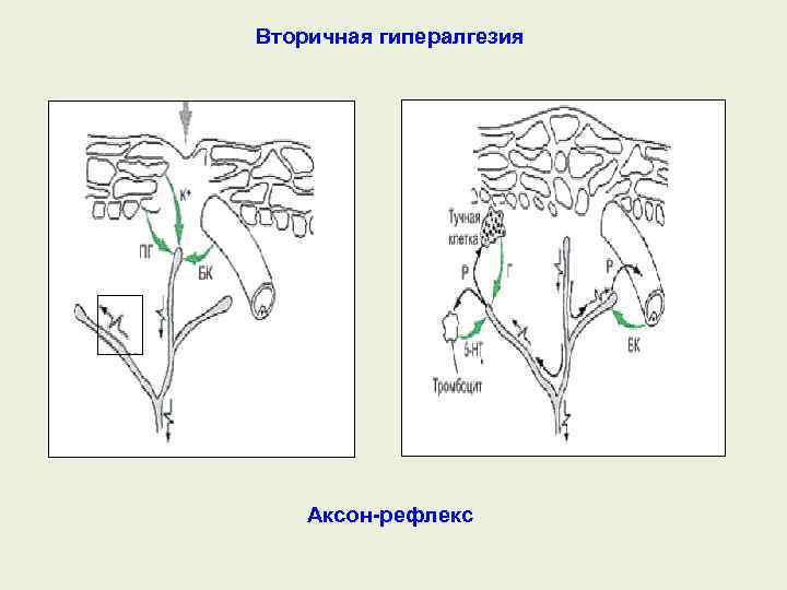 Вторичная гипералгезия Аксон рефлекс 