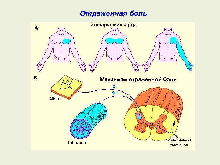 Отраженная боль Инфаркт миокарда A B Механизм отраженной боли Skin Intestine Anterolateral tract axon