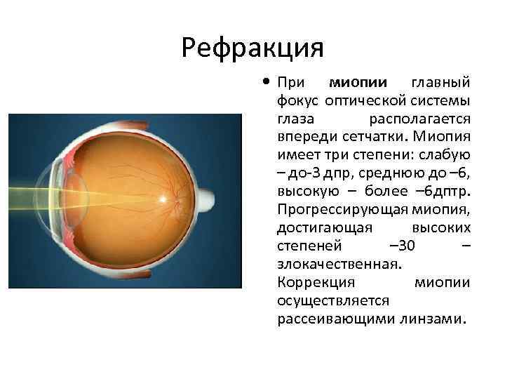 Миопия слабой степени обоих глаз