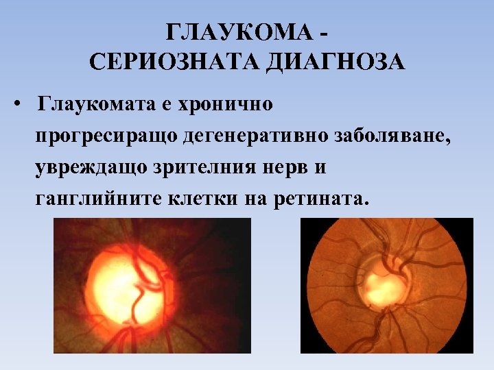 ГЛАУКОМА СЕРИОЗНАТА ДИАГНОЗА • Глаукомата е хроничнo прогресиращo дегенеративно заболяване, увреждащо зрителния нерв и