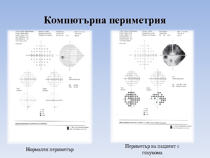 Компютърна периметрия Нормален периметър Периметър на пациент с глаукома 
