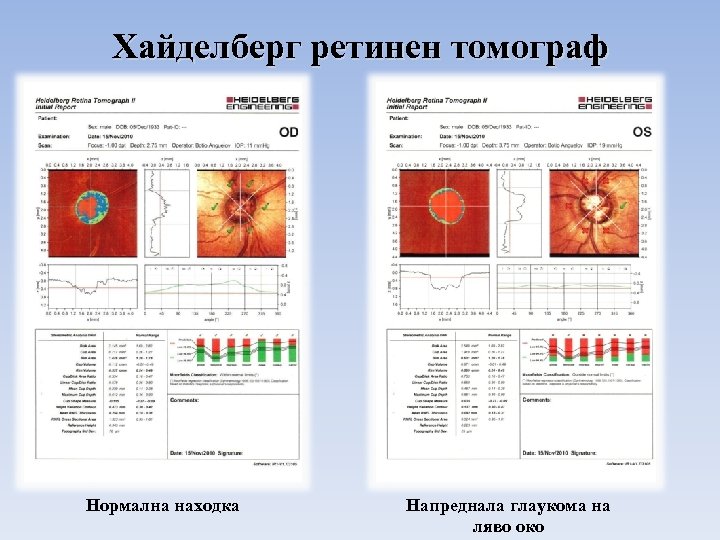 Хайделберг ретинен томограф Нормална находка Напреднала глаукома на ляво око 