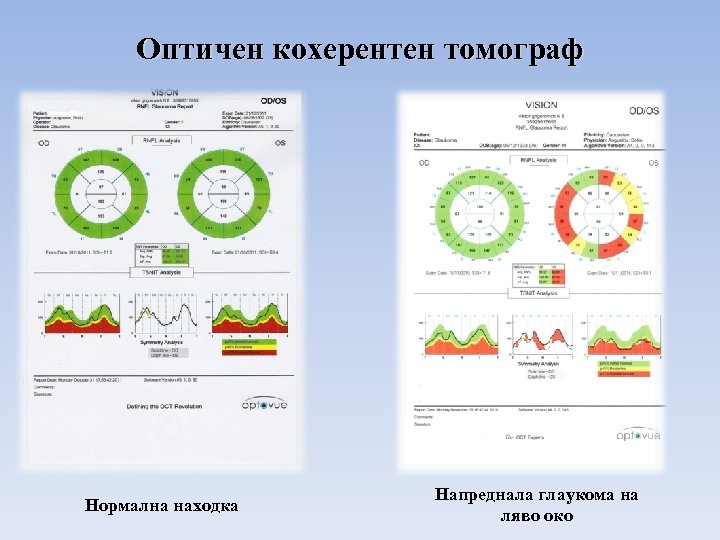 Оптичен кохерентен томограф Нормална находка Напреднала глаукома на ляво око 