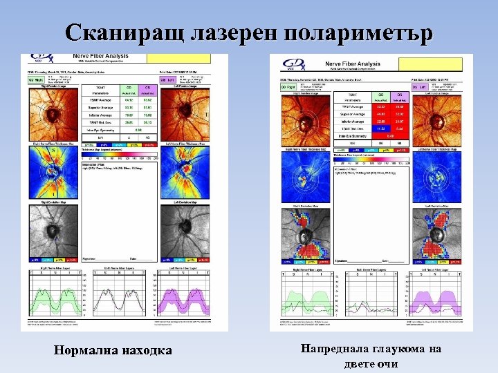 Сканиращ лазерен полариметър Нормална находка Напреднала глаукома на двете очи 