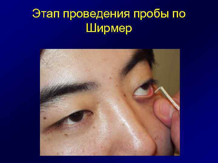 Этап проведения пробы по Ширмер 