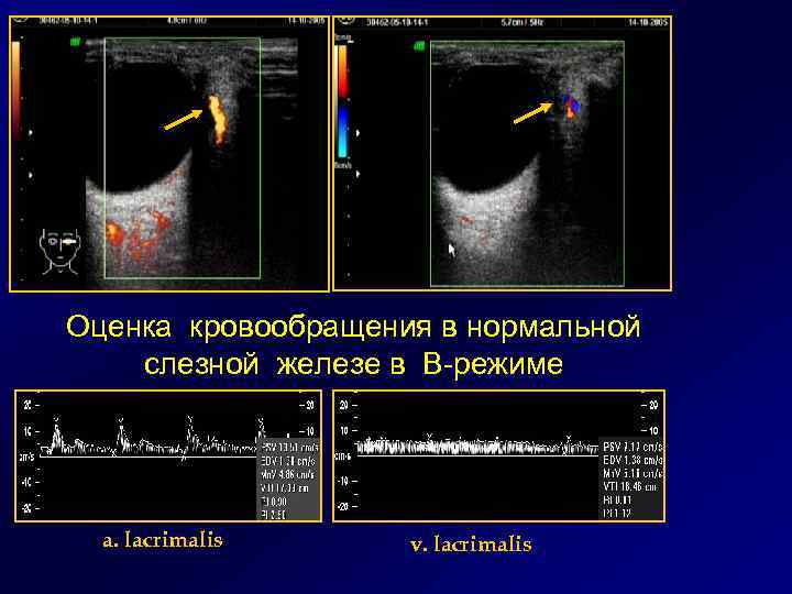 Оценка кровообращения в нормальной слезной железе в В-режиме a. lacrimalis v. lacrimalis 