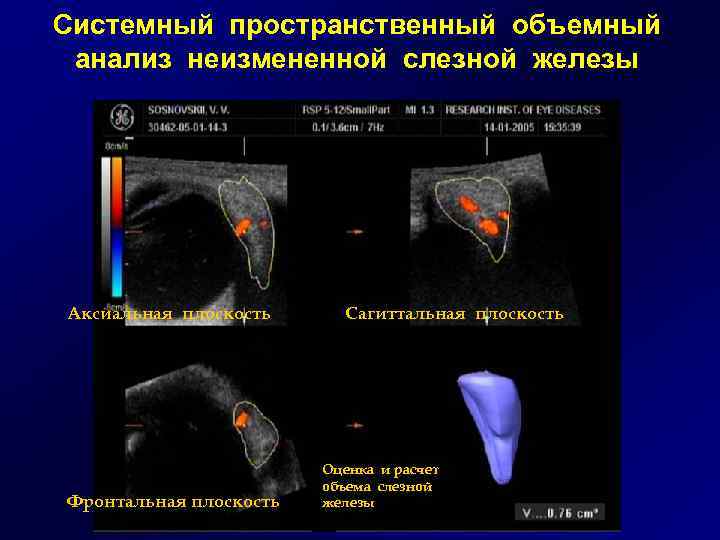 Системный пространственный объемный анализ неизмененной слезной железы Аксиальная плоскость Фронтальная плоскость Сагиттальная плоскость Оценка