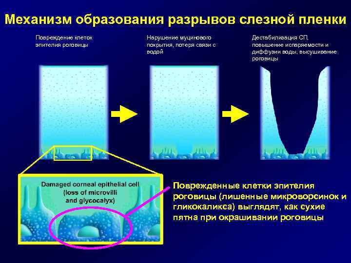 Образование с жидкостью. Муциновый слой слезной пленки. Строение слезной пленки. Механизм обновления слезной пленки. Функции слезной пленки.