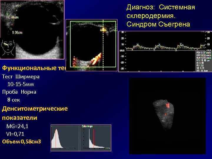 Диагноз: Системная склеродермия. Синдром Съегрена Функциональные тесты Тест Ширмера 10 -15 -5 мм Проба
