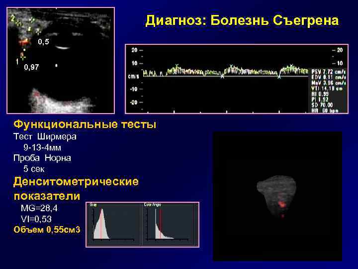 Диагноз: Болезнь Съегрена 0, 5 0, 97 Функциональные тесты Тест Ширмера 9 -13 -4