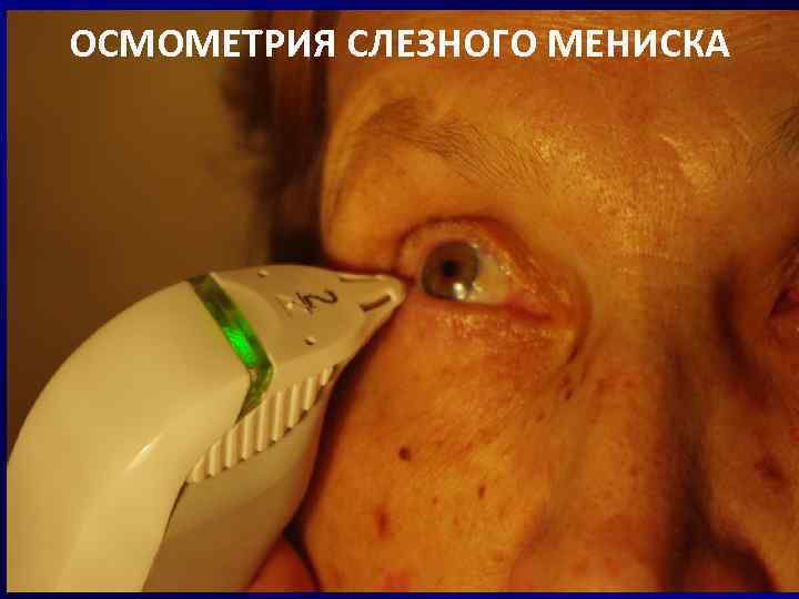 ОСМОМЕТРИЯ СЛЕЗНОГО МЕНИСКА 