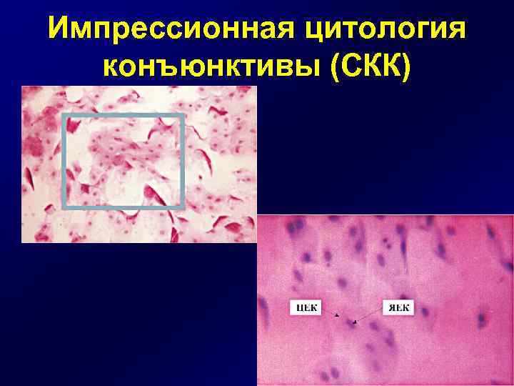 Импрессионная цитология конъюнктивы (СКК) 