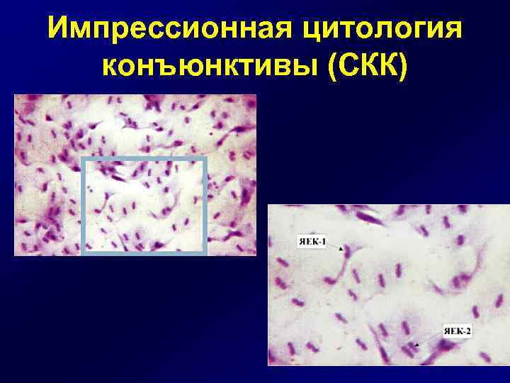 Импрессионная цитология конъюнктивы (СКК) 