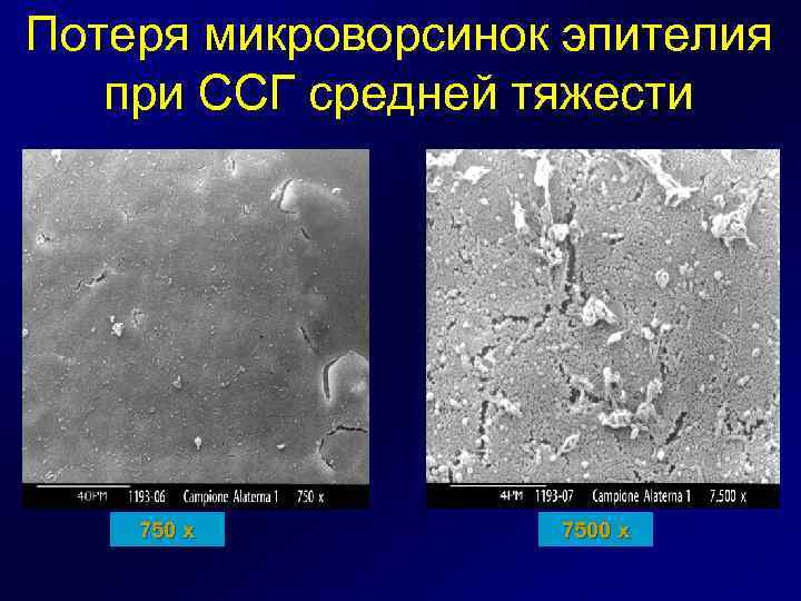 Потеря микроворсинок эпителия при ССГ средней тяжести 750 x 7500 x 