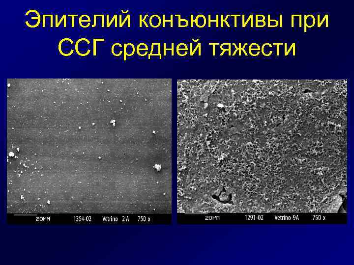 Эпителий конъюнктивы при ССГ средней тяжести 