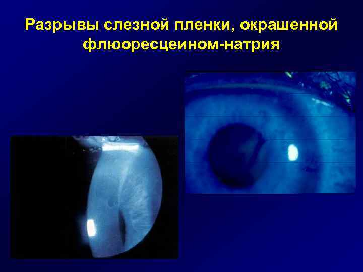 Разрывы слезной пленки, окрашенной флюоресцеином-натрия 