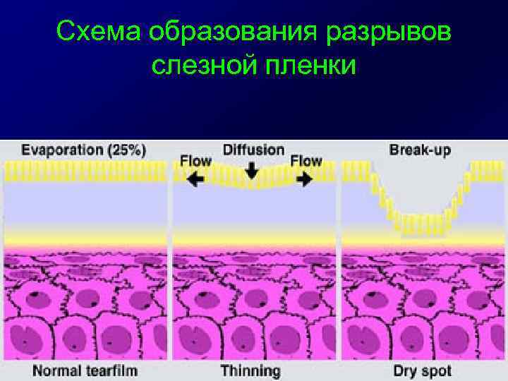 Схема образования разрывов слезной пленки 