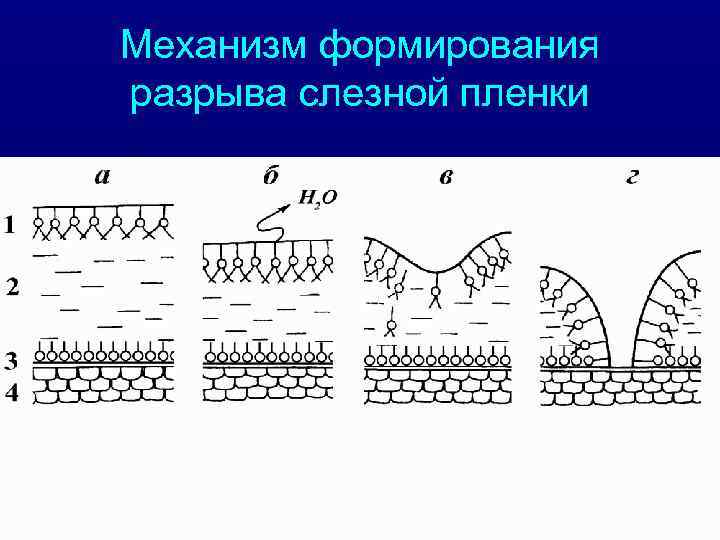 Механизм формирования разрыва слезной пленки 