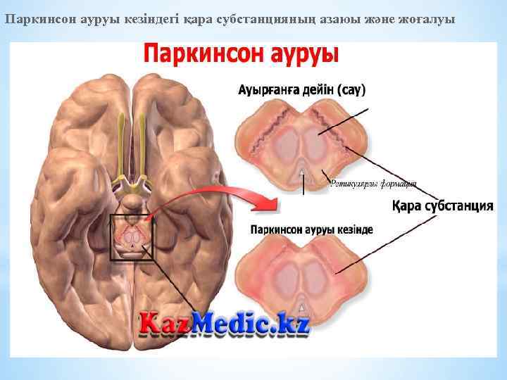 Паркинсон ауруы кезіндегі қара субстанцияның азаюы және жоғалуы 