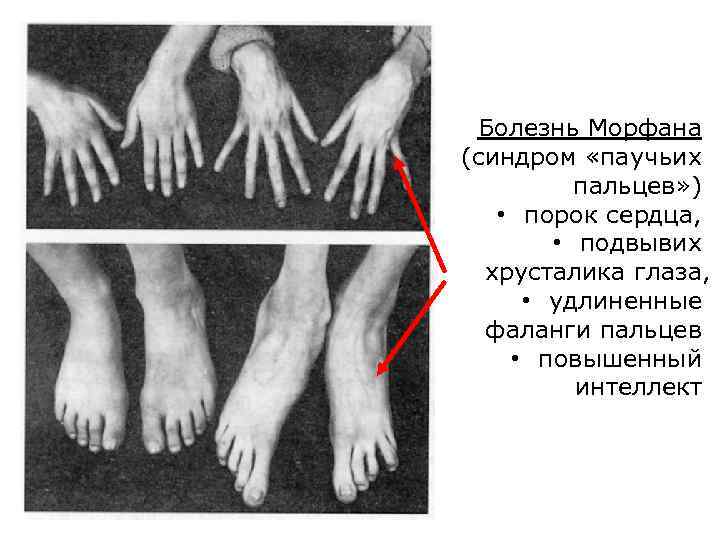 Болезнь Морфана (синдром «паучьих пальцев» ) • порок сердца, • подвывих хрусталика глаза, •