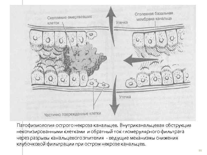 Патофизиология острого некроза канальцев. Внутриканальцевая обструкция некотизированными клетками и обратный ток гломерулярного фильтрата через