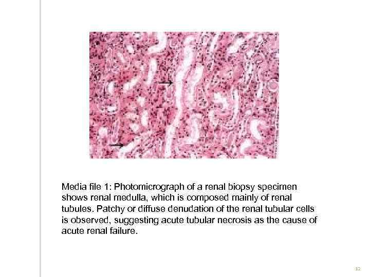 Media file 1: Photomicrograph of a renal biopsy specimen shows renal medulla, which is