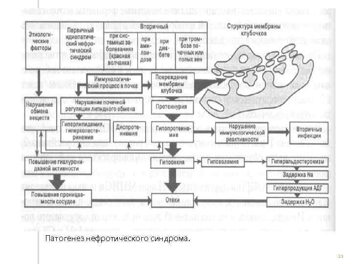 Патогенез нефротического синдрома. 21 