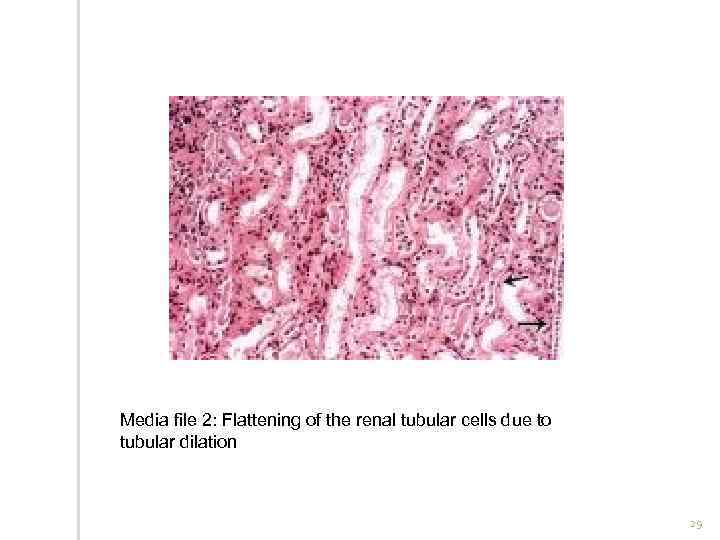 Media file 2: Flattening of the renal tubular cells due to tubular dilation 29