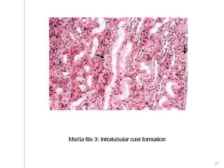 Media file 3: Intratubular cast formation 30 