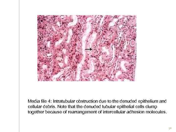 Media file 4: Intratubular obstruction due to the denuded epithelium and cellular debris. Note