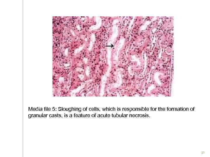 Media file 5: Sloughing of cells, which is responsible for the formation of granular