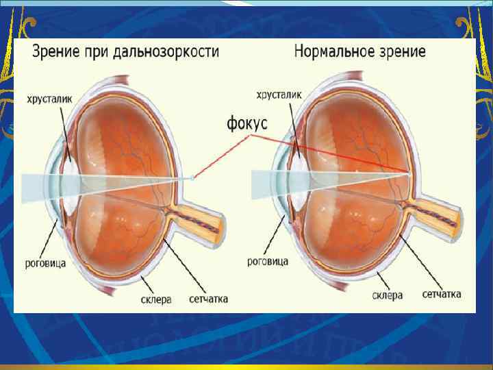 Линзы для зрения дальнозоркость. Строение глаза миопия. Близорукость строение глаза. Гиперметропия глаза это анатомия. Строение глаза заболевания близорукость.