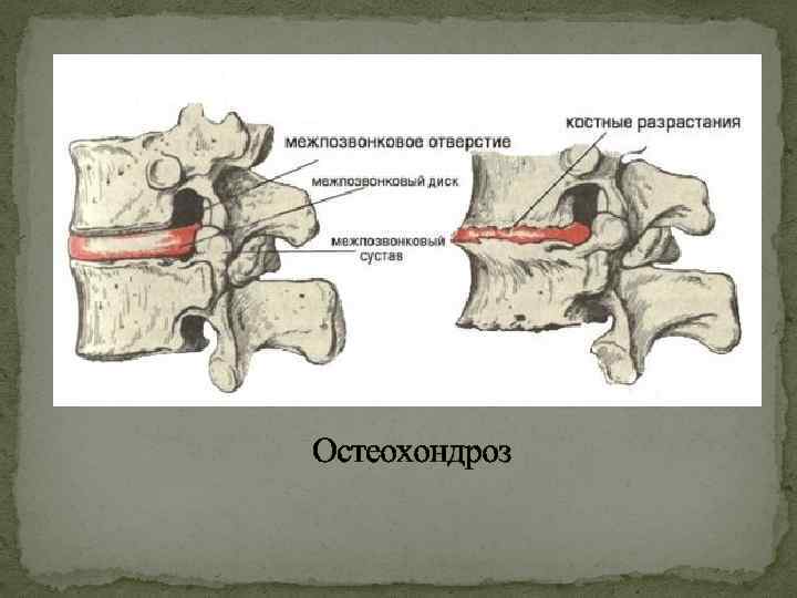 Остеохондроз 