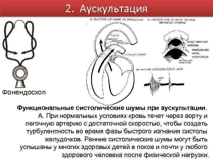 2. Аускультация Фонендоскоп Функциональные систолические шумы при аускультации. А. При нормальных условиях кровь течет