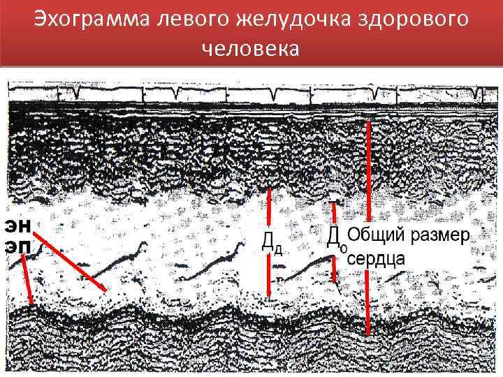 Эхограмма левого желудочка здорового человека 