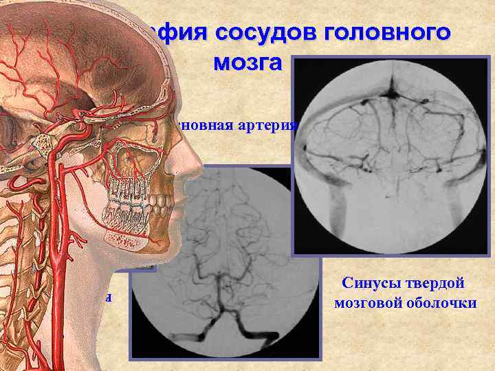 Ангиография сосудов головного мозга Основная артерия Внутренняя сонная артерия Синусы твердой мозговой оболочки 