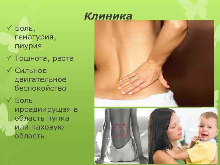 Клиника ü Боль, гематурия, пиурия ü Тошнота, рвота ü Сильное двигательное беспокойство ü Боль