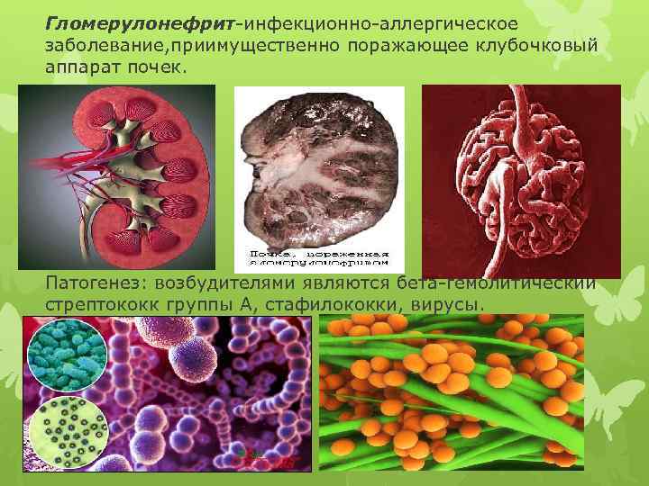 Гломерулонефрит-инфекционно-аллергическое заболевание, приимущественно поражающее клубочковый аппарат почек. Патогенез: возбудителями являются бета-гемолитический стрептококк группы А,