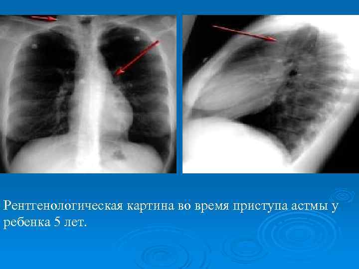 Для разгара рахита характерна следующая рентгенологическая картина