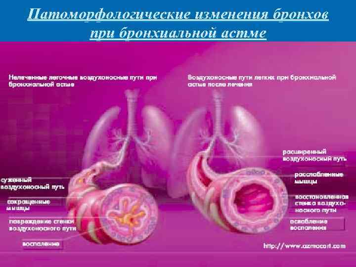 Патоморфологические изменения бронхов при бронхиальной астме 