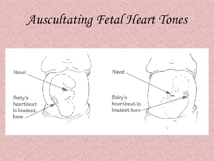 Auscultating Fetal Heart Tones 