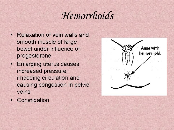 Hemorrhoids • Relaxation of vein walls and smooth muscle of large bowel under influence