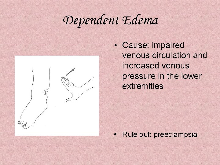 Dependent Edema • Cause: impaired venous circulation and increased venous pressure in the lower