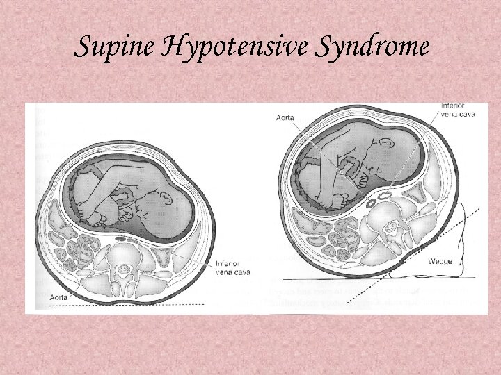 Supine Hypotensive Syndrome 