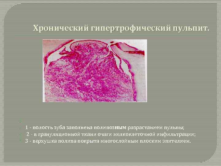 Хронический гипертрофический пульпит. 1 - полость зуба заполнена полипозным разрастанием пульпы; 2 - в