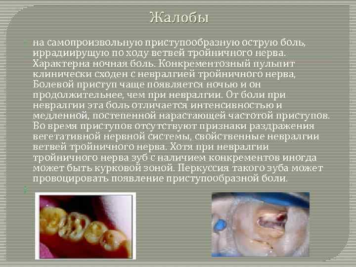 Жалобы на самопроизвольную приступообразную острую боль, иррадиирущую по ходу ветвей тройничного нерва. Характерна ночная