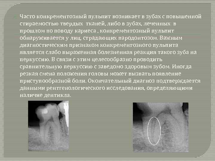  Часто конкрементозный пульпит возникает в зубах с повышенной стираемостью твердых тканей, либо в