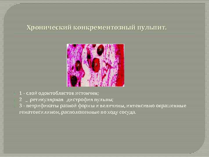 Хронический конкрементозный пульпит. 1 - слой одонтобластов истончен; 2 _ ретикулярная дистрофия пульпы; 3